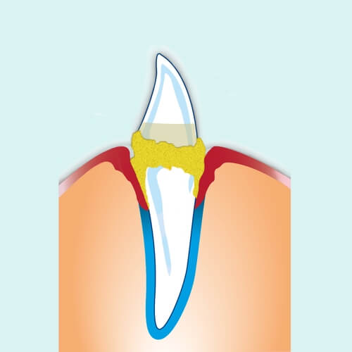 Tandsteen veroorzaakt tandvleesontsteking