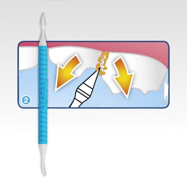 Bogadent-Tartar-Remover-gebruik-2 Bogadent-Tartar-Remover-gebruik-2